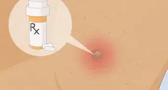 Remove an Ingrown Hair Under the Skin