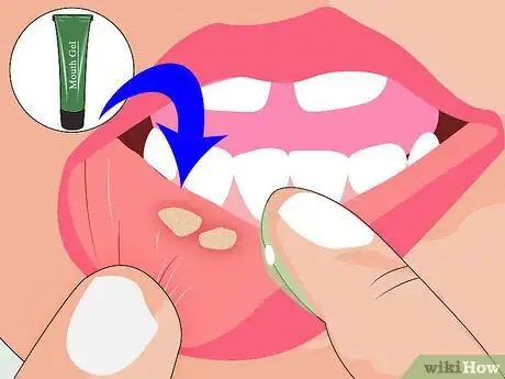 Image titled Avoid Getting Canker Sores Step 10