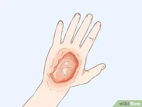 Image titled Get Rid of Poison Ivy Rashes Step 3