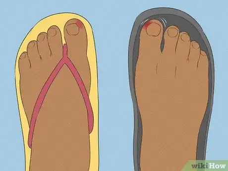 Image titled Will an Ingrown Toenail Heal Itself Step 5