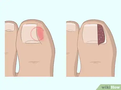 Image titled Relieve Ingrown Toe Nail Pain Step 26