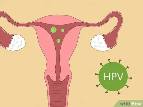 Image titled Recognize Vulva Cancer Symptoms Step 15