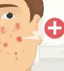 Get Rid of a Pimple