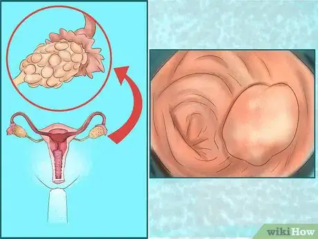 Image titled Know If Menstrual Periods Have Stopped Step 3