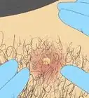 Prevent Ingrown Hairs on the Pubic Area