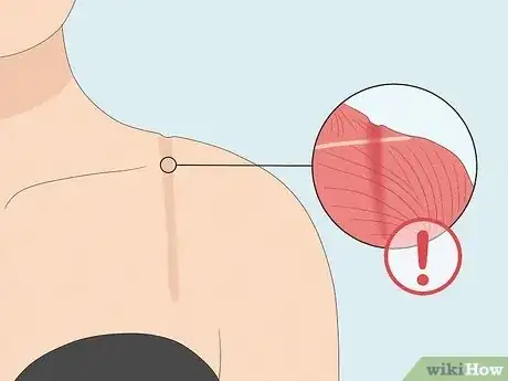 Image titled Get Rid of Bra Indentations on Shoulder Step 11