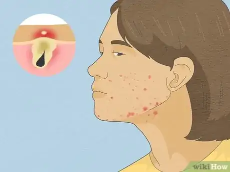 Image titled Tell if Acne Is Hormonal or Bacterial Step 1