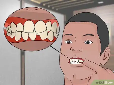 Image titled Determine if a Tooth Needs to Be Pulled Step 5