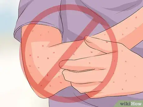 Image titled Recognize Chickenpox Step 11