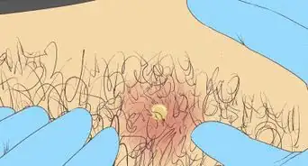 Prevent Ingrown Hairs on the Pubic Area