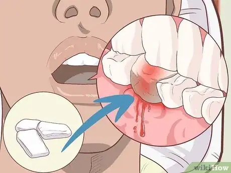 Image titled Prepare for Tooth Extraction Step 11