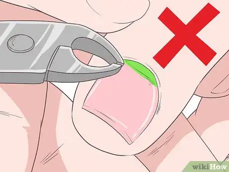 Image titled Get Rid of Psoriasis on Your Nails Step 14