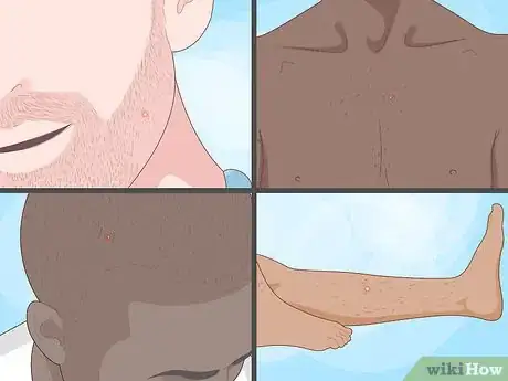 Image titled Spot Ingrown Hairs Step 1