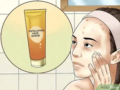 Image titled Get Rid of Forehead Acne Step 12