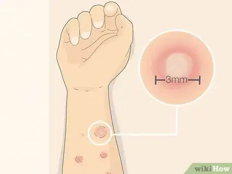 Image titled Read Allergy Skin Test Results Step 8