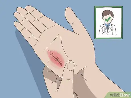 Image titled Prevent a Cut from Getting Infected Step 13