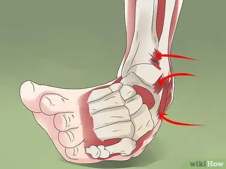 Image titled Tape a High Ankle Sprain Step 16