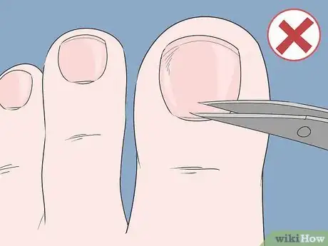 Image titled Treat a Hangnail Infection Step 16