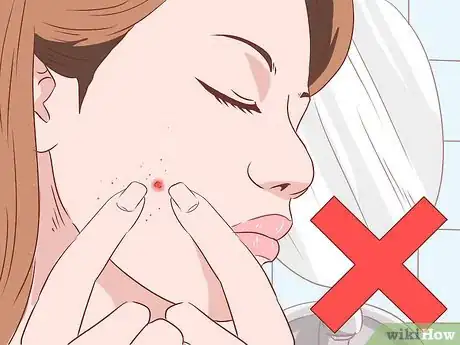 Image titled Stop a Zit from Bleeding Step 8