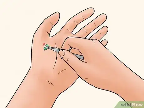 Image titled Remove a Pin or Tack from Your Skin Step 4