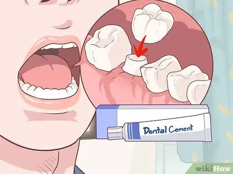 Image titled Fix a Lost Dental Crown Step 1