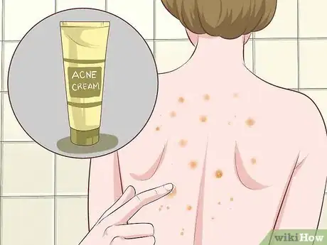 Image titled Get Rid of Back Acne Fast Step 3