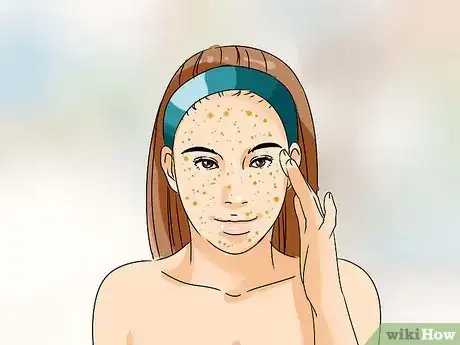 Image titled Remove a Blackhead from Your Forehead Step 8