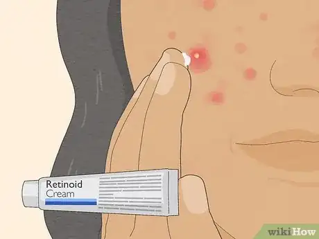 Image titled Get Rid of Cystic Acne Scars Step 22