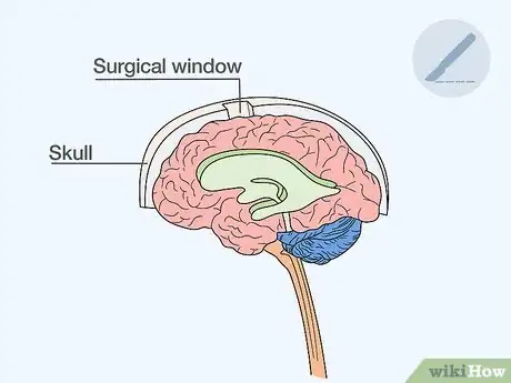 Image titled Reduce Brain Swelling Step 8