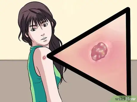 Image titled Recognize Skin Bacterial Infections Step 15