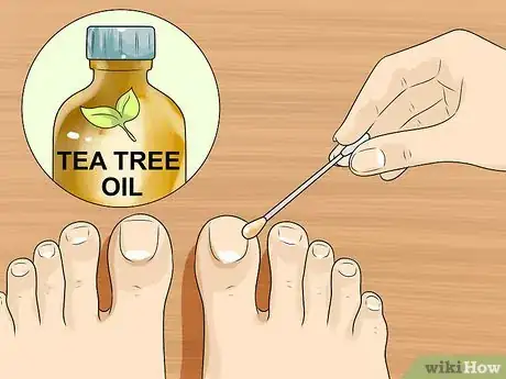 Image titled Cure Toenail Fungus with Vinegar Step 5