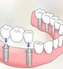 Keep Bottom Dentures in Place