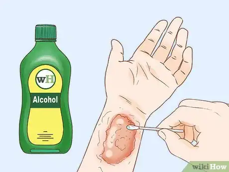 Image titled Get Rid of Poison Ivy Rashes Step 5