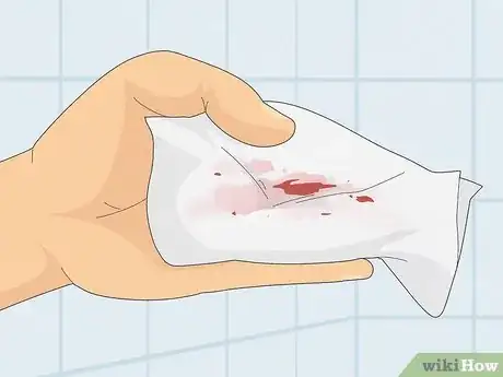 Image titled Stop Rectal Bleeding Step 1