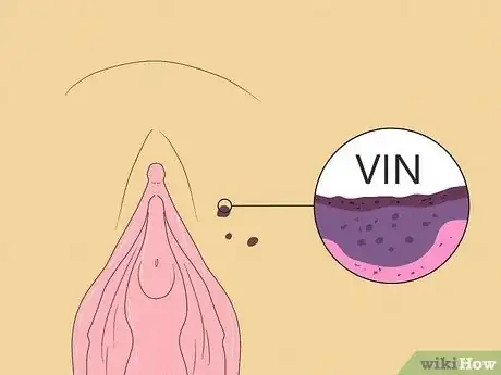 Image titled Recognize Vulva Cancer Symptoms Step 18
