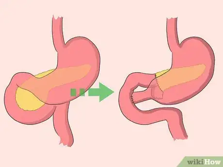 Image titled Keep Your Pancreas Healthy Step 16