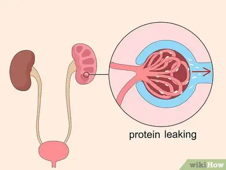 Image titled Reduce Foamy Urine Step 5