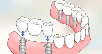 Keep Bottom Dentures in Place