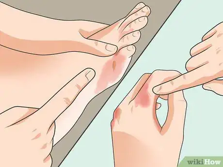 Image titled Diagnose Psoriasis Step 4