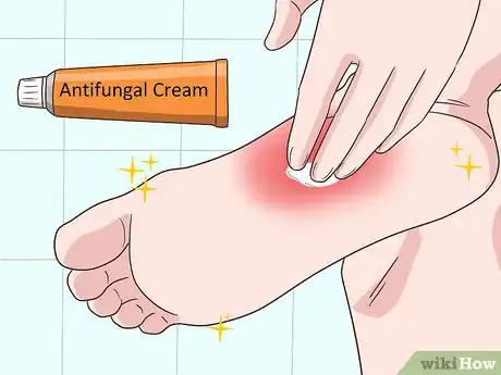 Image titled Treat Tinea Step 3