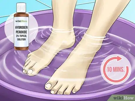 Image titled Clean Toe Nails Step 9