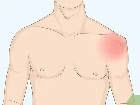 Image titled Fix a Dislocated Shoulder Step 1
