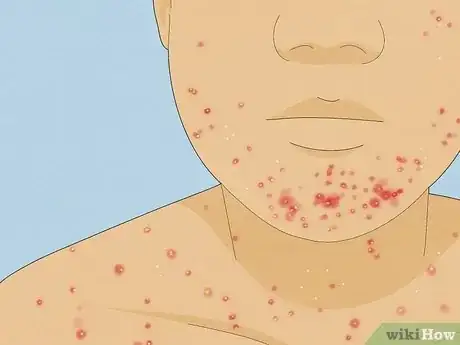 Image titled Tell if Acne Is Hormonal or Bacterial Step 21