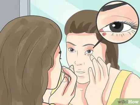 Image titled Recognize an Eyelid Cyst Step 1