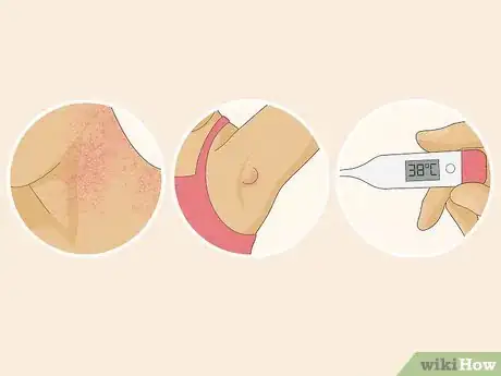 Image titled Treat Heat Rash Step 1