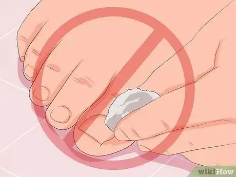 Image titled Remove Infection from an Ingrown Toenail Step 9