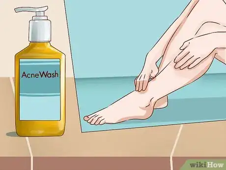 Image titled Get Rid of Leg Acne Step 7