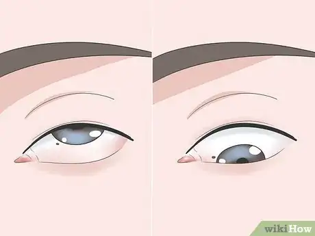 Image titled Get Sand Out of Your Eyes Step 8