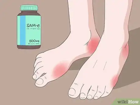 Image titled Cure Arthritis in Feet Naturally Step 3