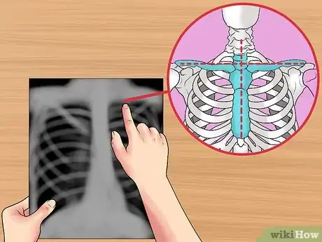 Image titled Read a Chest X Ray Step 6